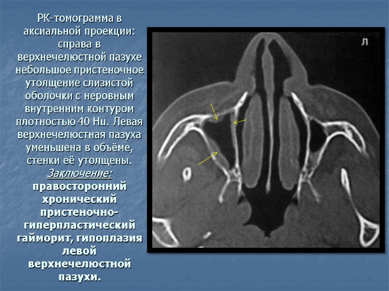 РК-томограмма в аксиальной проекции: справа в верхнечелюстной пазухе небольшое пристеночное утолщение слизистой оболочки с
